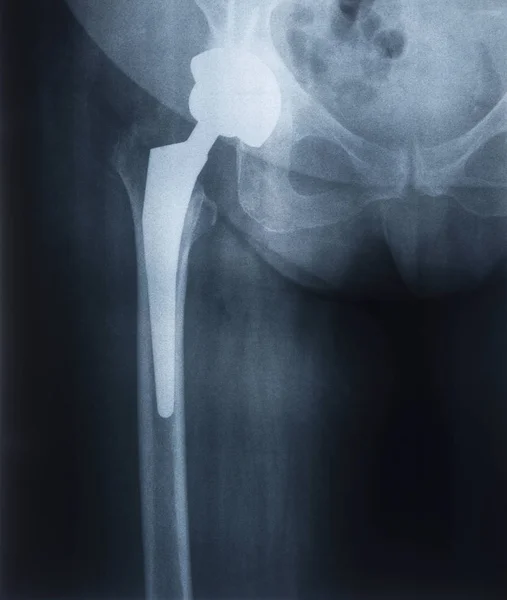 X-ray of a prosthesis of a female hip joint. Joint endoprosthetics