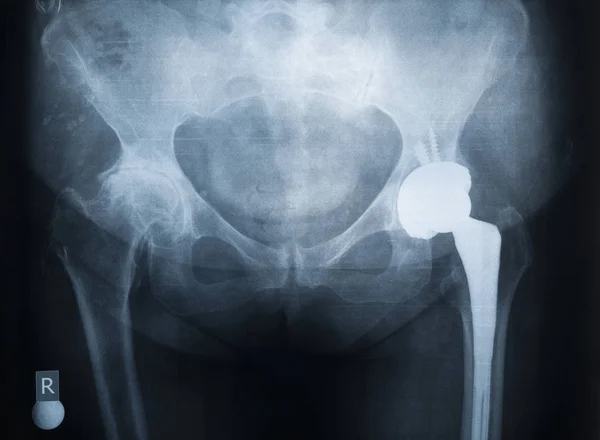 Radiografia da prótese da articulação do quadril esquerdo. A articulação direita é afetada pela artrite reumatoide — Fotografia de Stock