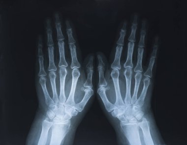 X-ray of hands. Medicine and health. Horizontal photo
