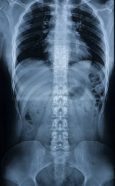 X-ray of a mans body. Spine, pelvic bones, ribs, internal organs