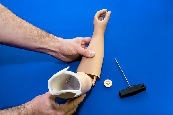 Mãos ajustando o braço protético . — Fotografia de Stock