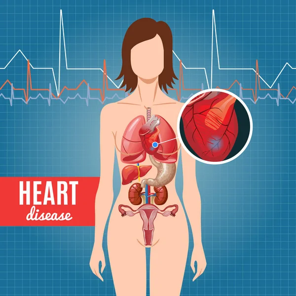 Cartel de enfermedad cardíaca de dibujos animados — Vector de stock