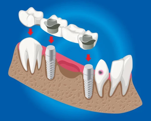 Isometric Prosthetic Dentistry Concept — Stock Vector