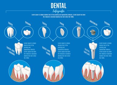 İzometrik protez diş hekimliği Infographic kavramı