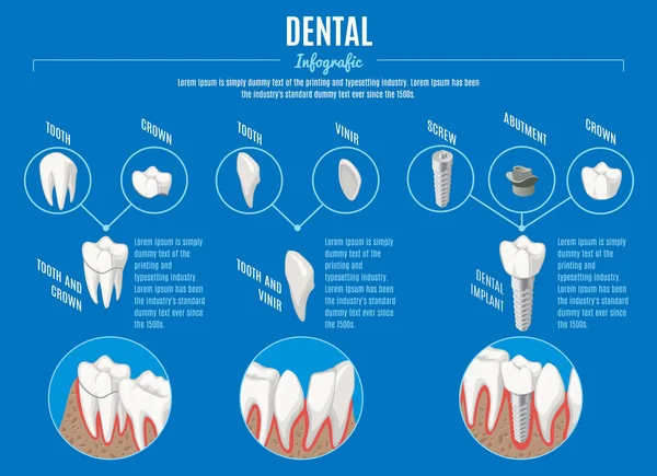 Isometric Prosthetic Dentistry Infographic Concept — Stock Vector