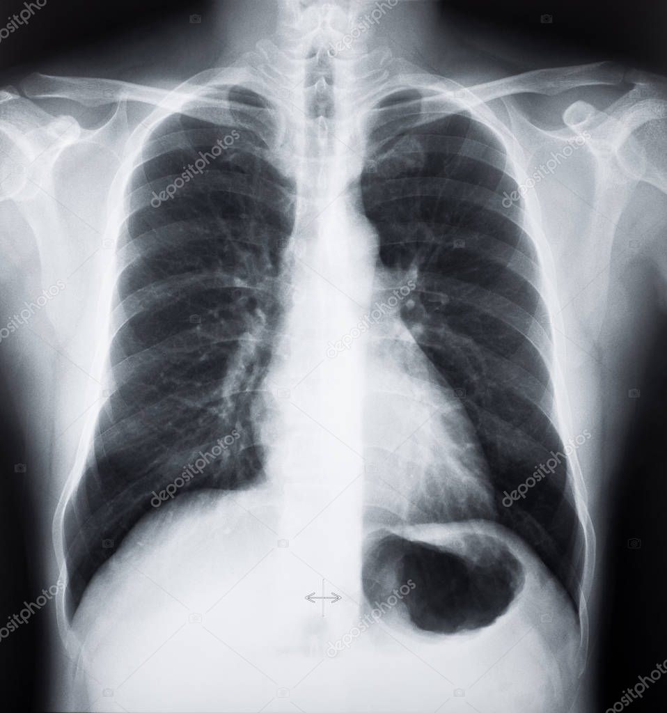 X-ray images of Human chest or lung. CT Scan Film.