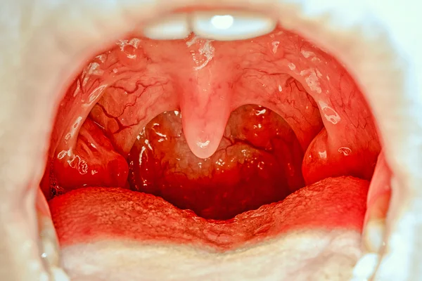 Macro bocca aperta con tonsilla alla gola — Foto Stock