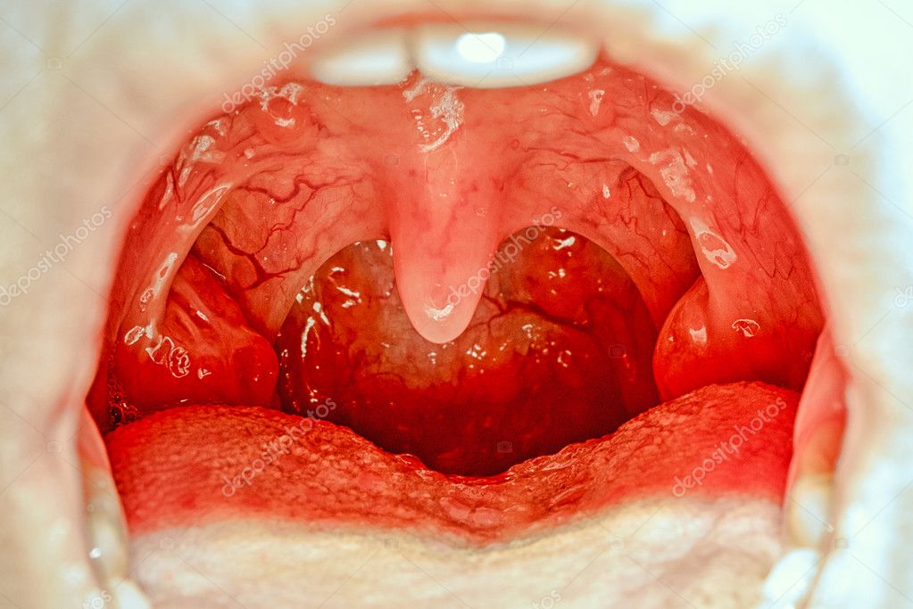 Как Выглядят Миндалины Фото