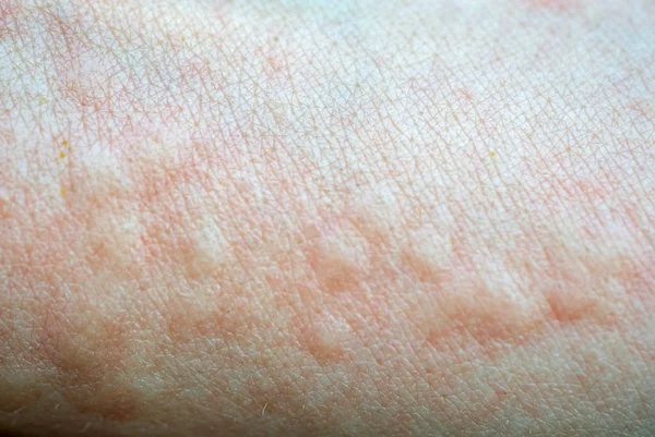 Bolhas em uma textura de pele de perto — Fotografia de Stock