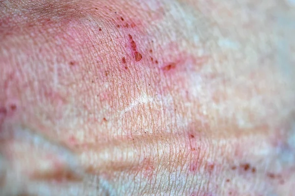 Doença ruim textura da pele de perto — Fotografia de Stock