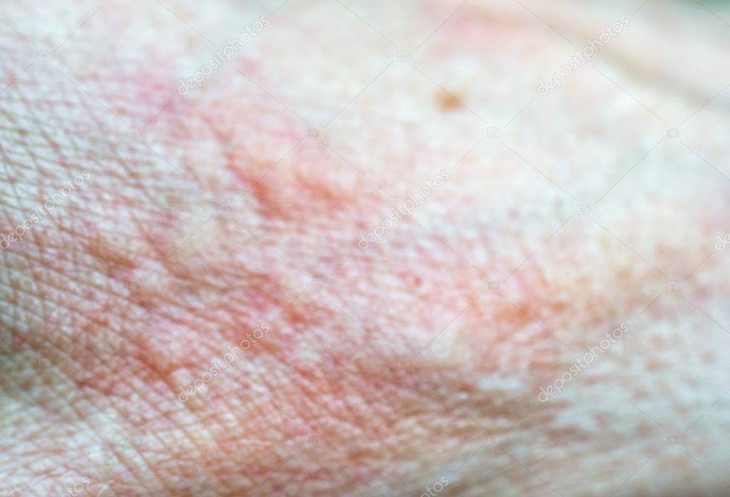 blisters on a skin texture close up