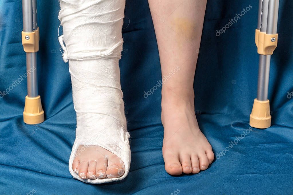 Контрактура голеностопного сустава лфк. Как лечить ноги после перелома. Ортез при переломе большеберцовой кости. Физиотерапия после перелома ноги. Как лечить ноги после перелома.
