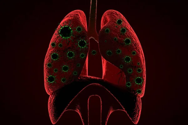 Lékařské Ilustrace Infikované Koronavirem Covid Virus Chřipky Respiračních Buněk Číně — Stock fotografie