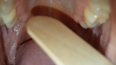 Depressor ile 25 yaşındaki bir çocuğun ağız boşluğu