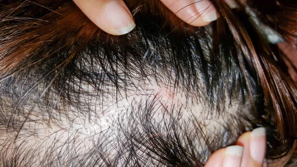 Abscess on skin head — Stock Photo, Image