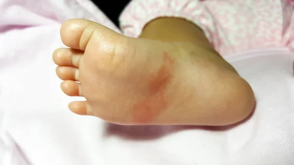 Close-up newborn baby feet skin athletes foot psoriasis — Stock Photo, Image