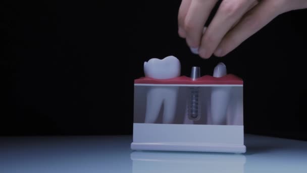 Close-up of the dental implant. The doctor demonstrates the dental implant system. — Stockvideo