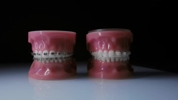 Close-up of teeth with metal and transparent braces. Comparison of different braces — Stok video