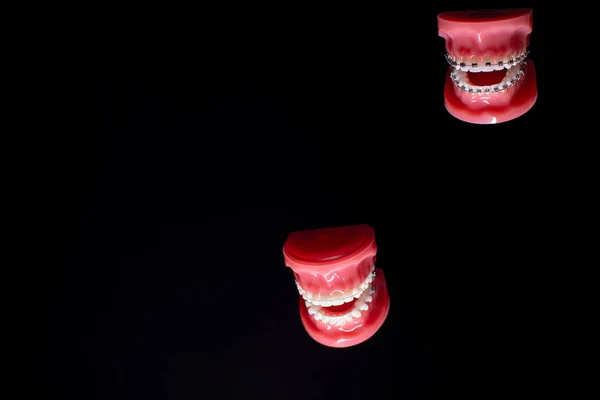 Close-up of teeth with metal and transparent braces. Comparison of different braces — Stock Photo, Image