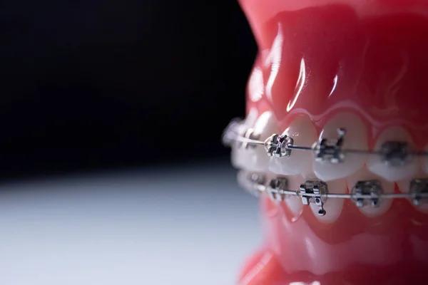 Close-up of teeth with metal braces. The jaw with braces turns on the surface. — Stock Photo, Image