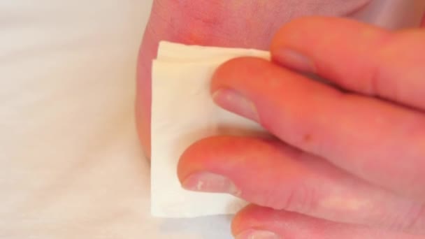 Hand drying and cleaning cracked bloody blister on heel with paper tissue. A painful place with torn skin,  bloody and wetted wound with skin tresses. — Stock Video