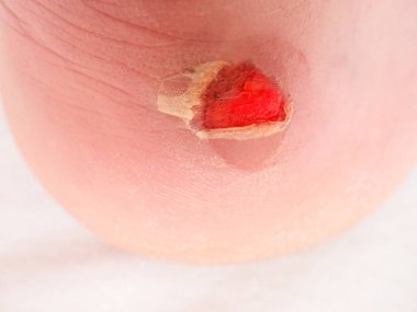 Kurutma ve temizlik topuk üzerinde kanlı blister kırık. Çok acı bir yırtık deri ile