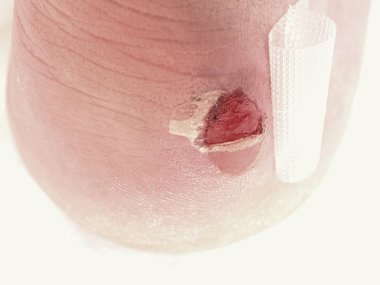  Craced korkunç blister insan topuk üzerinde. Adam ayak yapıştırıcı sıva ile