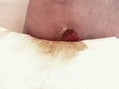 Craced korkunç blister insan topuk üzerinde. Adam ayak kanlı acı cilt.