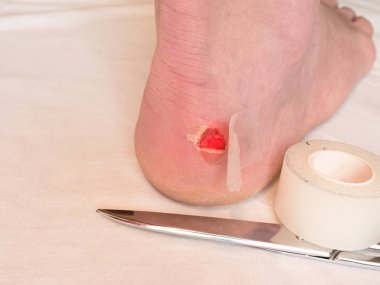 Topuk bandaj ile makas hazır yara. Craced korkunç blister insan topuk üzerinde. 