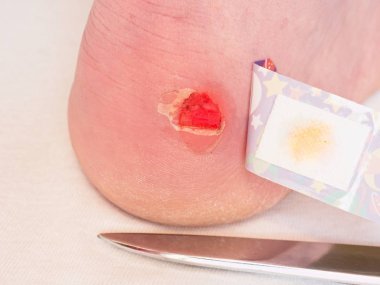 Topuk bandaj ile yara. Adam ayak yapıştırıcı sıva ile kanlı acı cilt ıslak