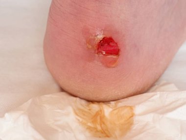 Kurutma ve temizlik topuk üzerinde kanlı blister kırık. Çok acı bir yırtık deri ile