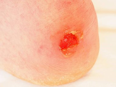 Kurutma ve temizlik topuk üzerinde kanlı blister kırık. Çok acı bir yırtık deri ile