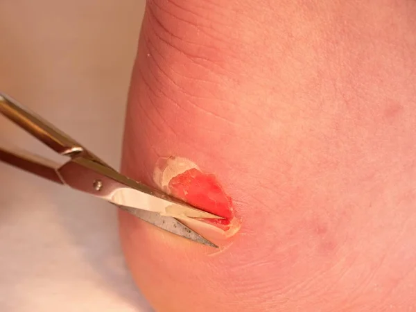 Makas kırık kanlı blister topuk üzerinde kuru deriyi kesme. Çok acı bir yırtık deri ile — Stok fotoğraf