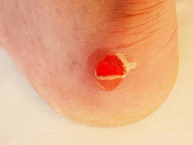 Kurutma ve temizlik topuk üzerinde kanlı blister kırık. Çok acı bir yırtık deri ile