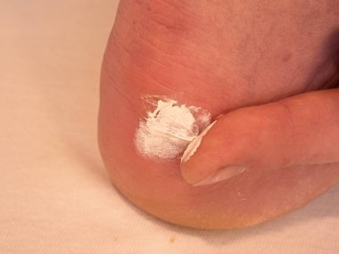 Kurutma ve temizlik el topuk üzerinde kanlı blister kırık. Kanlı ve ıslak yırtık deri ile acı bir yer yara 