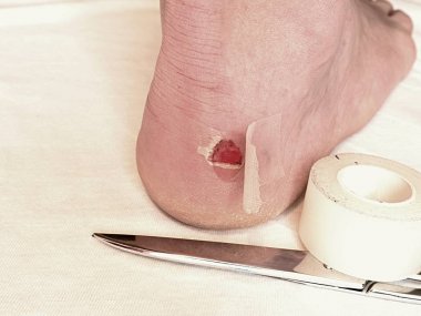 Topuk yara, sopa bandaj ve makas. Craced korkunç blister insan topuk üzerinde. 
