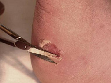 Makas kırık kanlı blister topuk üzerinde kuru deriyi kesme. Çok acı bir yırtık deri ile
