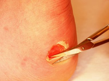 Makas kırık kanlı blister topuk üzerinde kuru deriyi kesme. Çok acı bir yırtık deri ile