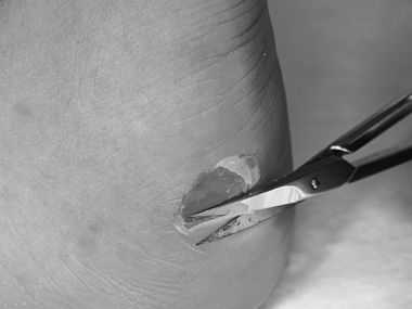 Küçük çökmekten makas adam topuk üzerinde kırık blister, deriyi kesme. Yırtık deri ile acı yer,