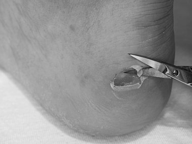 Küçük çökmekten makas adam topuk üzerinde kırık blister, deriyi kesme. Yırtık deri ile acı yer,