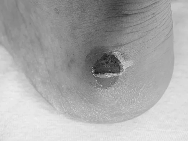 Ужасная волдырь на каблуке человека. Чертовски болезненная кожа на ноге человека . — стоковое фото