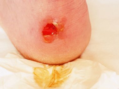 Kurutma ve temizlik topuk üzerinde kanlı blister kırık. Çok acı bir yırtık deri ile