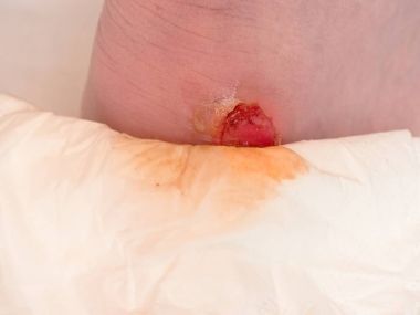 Kurutma ve temizlik topuk üzerinde kanlı blister kırık. Çok acı bir yırtık deri ile