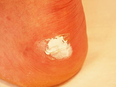 Kanlı ve ıslak yırtık deri ile acı bir yer deri saçları ile yara. Şifa merhem beyaz ile tedavi