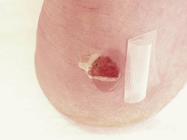  Craced korkunç blister insan topuk üzerinde. Adam ayak yapıştırıcı sıva ile
