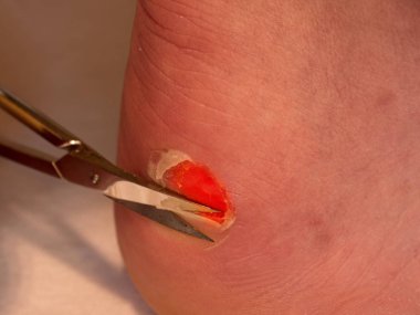 Makas kırık kanlı blister topuk üzerinde kuru deriyi kesme. Çok acı bir yırtık deri ile