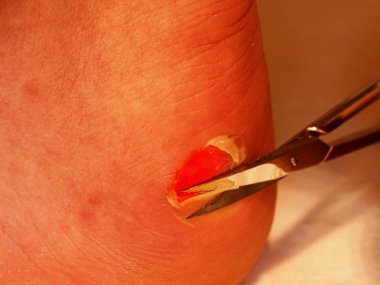 Küçük çökmekten makas adam topuk üzerinde kırık blister, deriyi kesme. Yırtık deri ile acı yer,