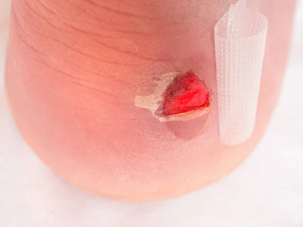 Рана на каблуке с бинтом. Мокрая кровавая болезненная кожа на ноге человека с помощью клея штукатурки — стоковое фото