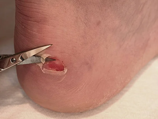 Small bended scissors cut skin at  cracked blister on man heel. Painful place with torn skin,