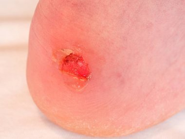 Kurutma ve temizlik topuk üzerinde kanlı blister kırık. Çok acı bir yırtık deri ile